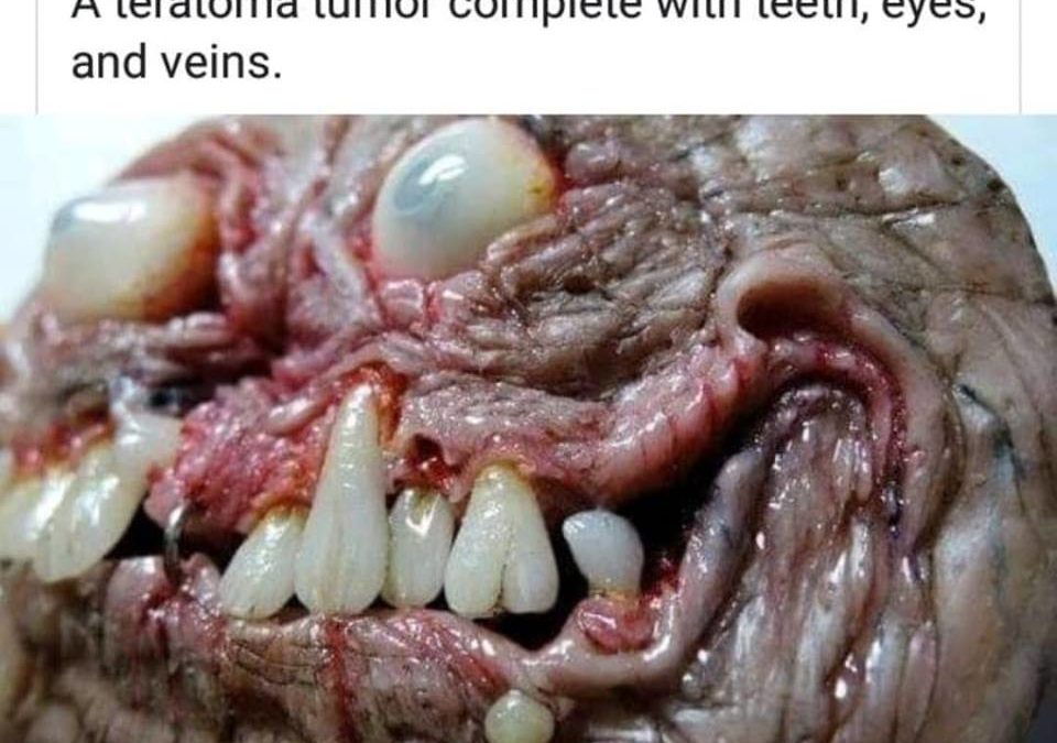 Teratoma Tumor: The demonic mass that grows teeth, eyes, feet, and organs