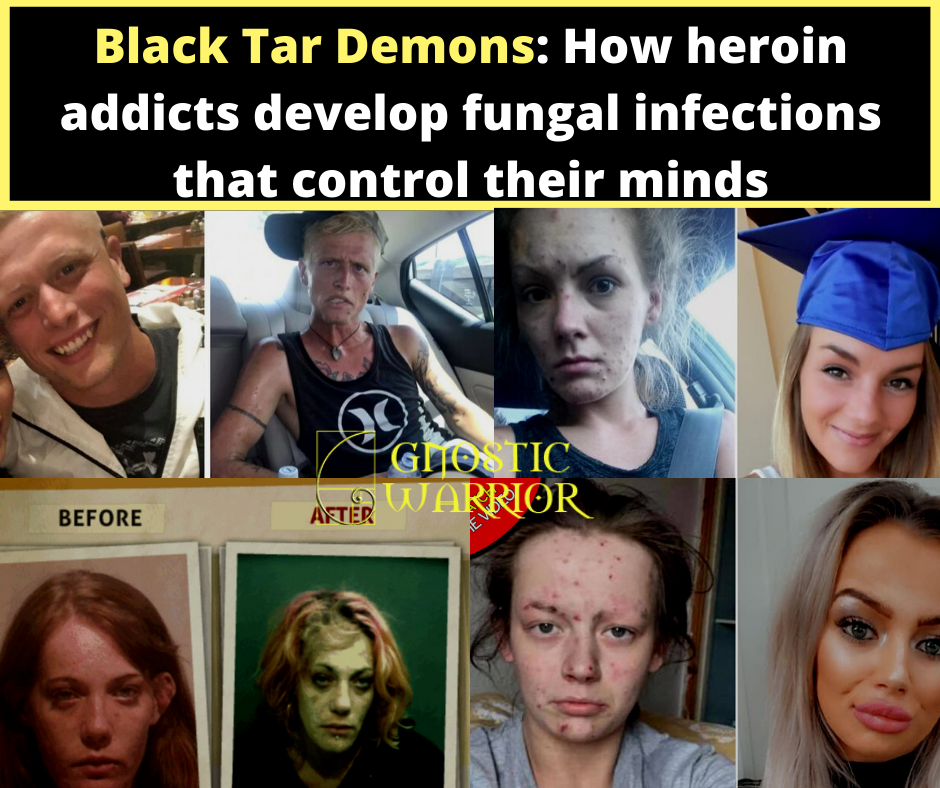Black Tar Demons: How heroin addicts develop fungal infections that control their minds